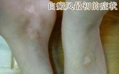 白癜风患者吃什么能预防疾病 白癜风患者吃什么能预防疾病