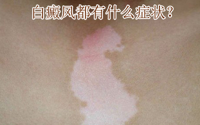 怎么诊断泛发型白癜风 怎么诊断泛发型白癜风