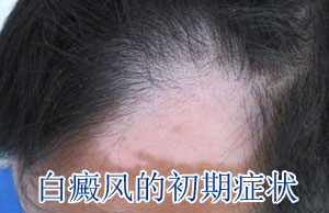 白癜风自我诊断的方法有哪些 白癜风自我诊断的方法有哪些
